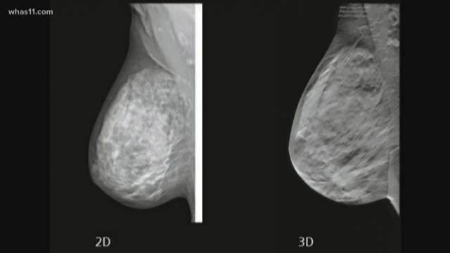 The Difference Between 2D And 3D Mammograms | WHAS11.com